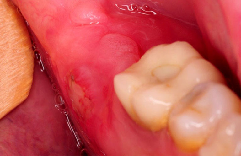 Nguyên nhân gây viêm tủy răng có mủ