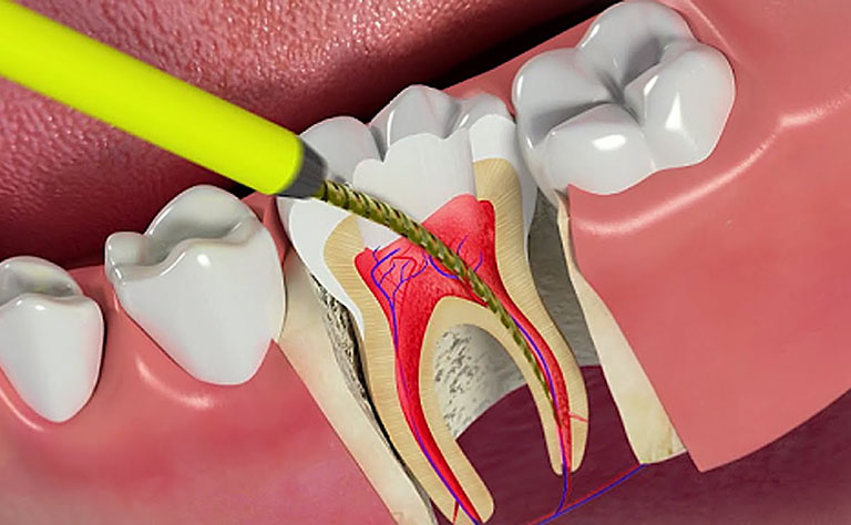 Phương pháp điều trị viêm tủy răng có mủ