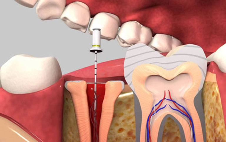 Vì sao chữa viêm tủy răng xong vẫn đau nhức?