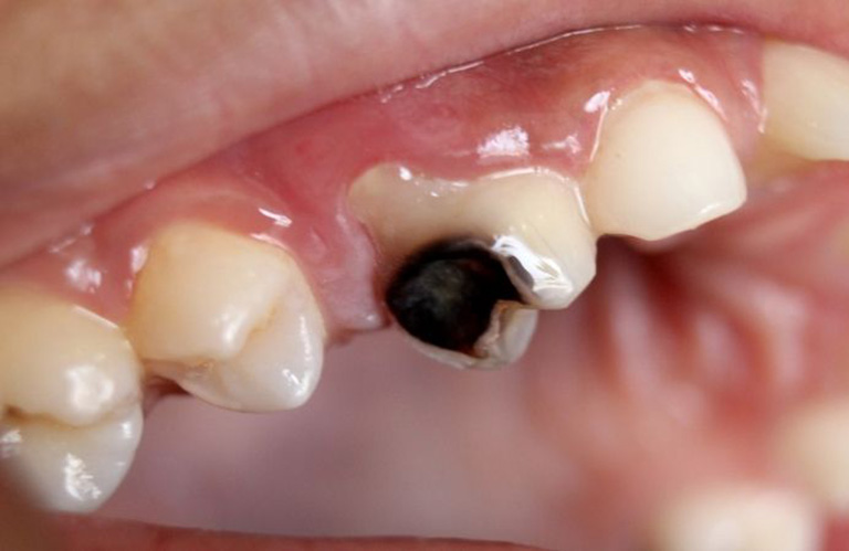 Nguyên nhân gây đau răng nổi hạch