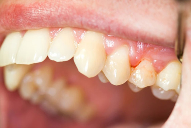 Nguyên nhân gây đau răng số 7