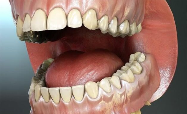 Ê buốt răng hàm trên có nguy hiểm không?