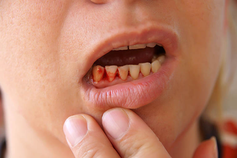 Ê buốt răng và chảy máu chân răng là gì?