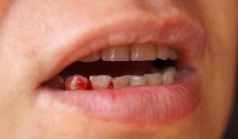Nguyên nhân gây ê buốt răng và chảy máu chân răng