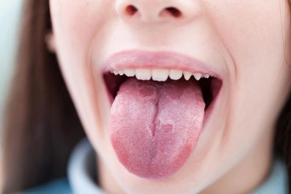 Khô miệng rát lưỡi là gì? Triệu chứng thường gặp