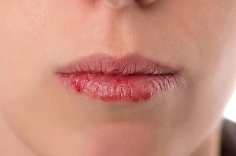 Khô môi và nhiệt miệng là gì?