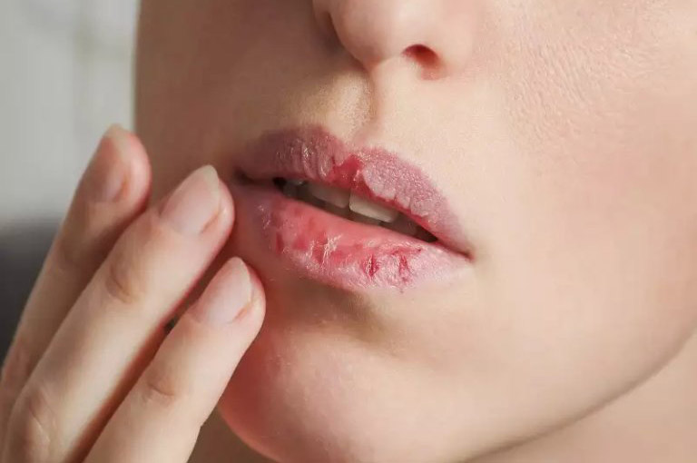 Khô môi và nhiệt miệng có nguy hiểm không?