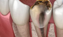 Nhiễm trùng tủy răng là gì?