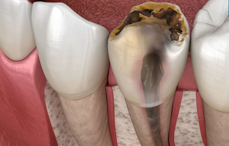 Nhiễm trùng tủy răng là gì?