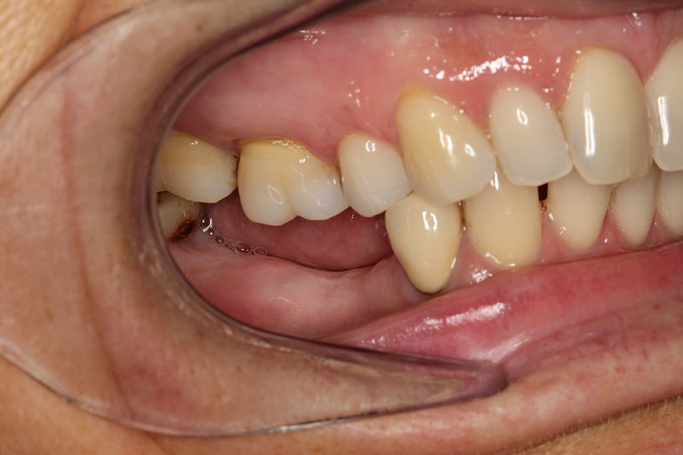 Tác hại nhiễm trùng tủy răng gây ra là gì?