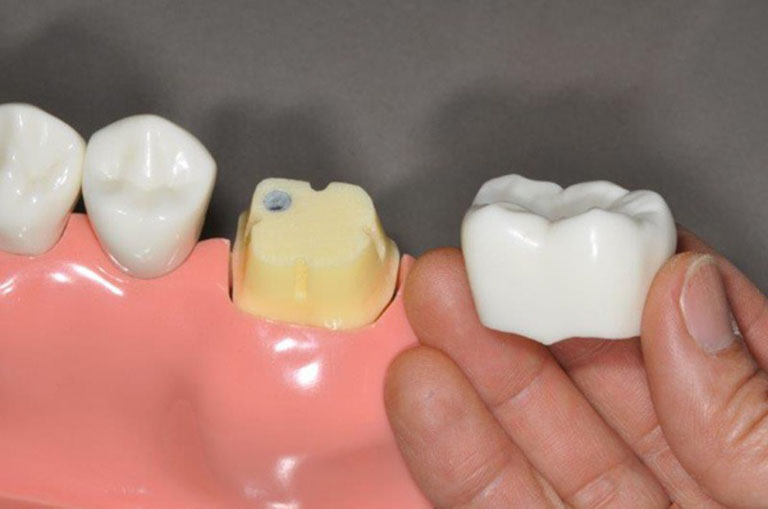Phương pháp giúp bảo tồn răng lấy tủy tốt nhất