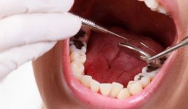 Răng khôn bị viêm tủy là gì?