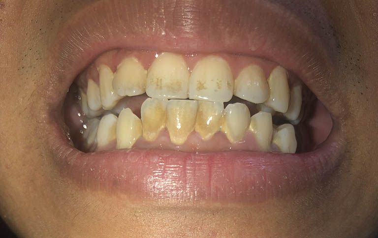 Răng ngả màu sau lấy tủy do nguyên nhân nào?