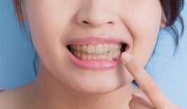 Răng ngả màu sau lấy tủy có nguy hại không?