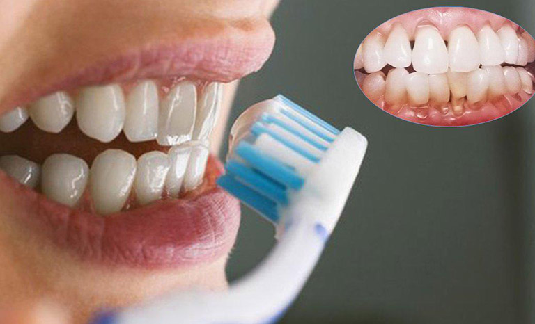 Giải pháp cải thiện răng ngả màu sau lấy tủy