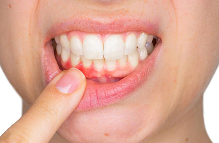 Sưng nướu răng có mủ là gì? Có nguy hiểm không?