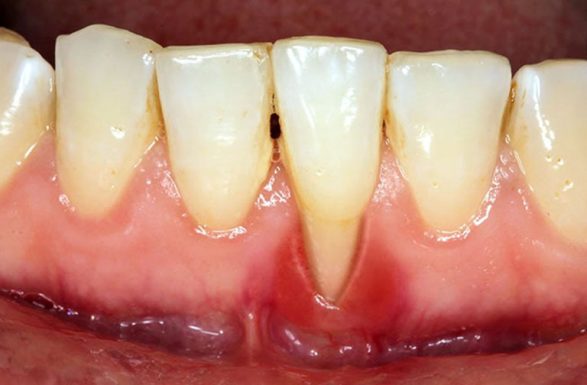 Tụt lợi răng lung lay là gì? Các giai đoạn phát triển