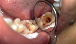 Tủy răng bị hoại tử là gì? Có nguy hiểm không?