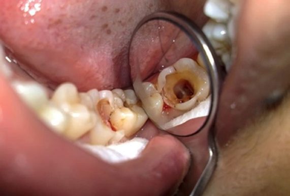 Tủy răng bị hoại tử là gì? Có nguy hiểm không?
