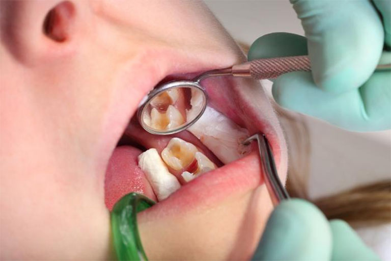 Triệu chứng khi tủy răng bị thối