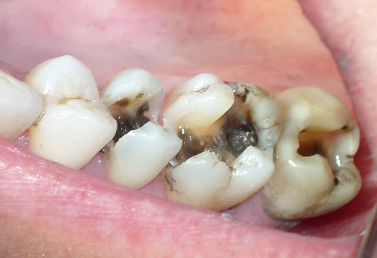 Tủy răng bị thối nguy hiểm như thế nào?