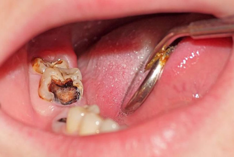 Phương pháp điều trị tủy răng bị thối