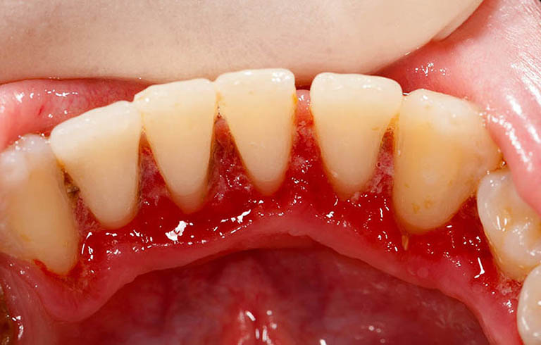 Viêm lợi có niềng răng được không?