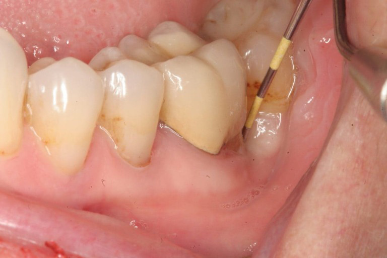 Vai trò của vitamin đối với sức khỏe răng miệng