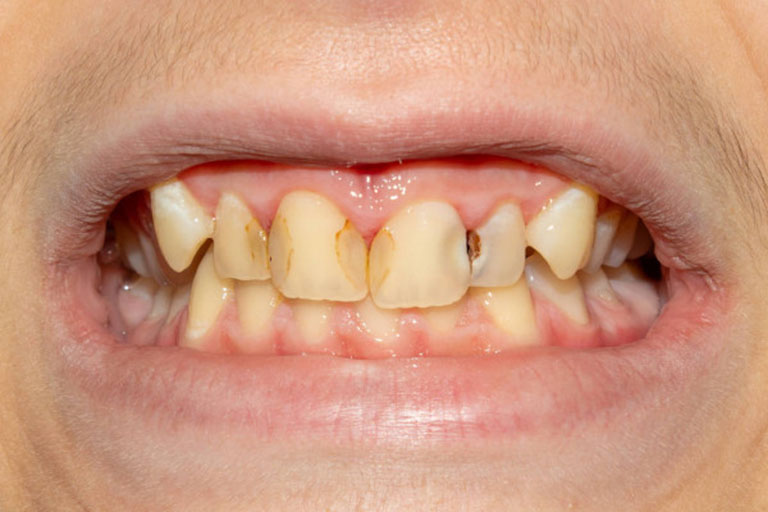 Triệu chứng nhận biết viêm tủy răng cửa