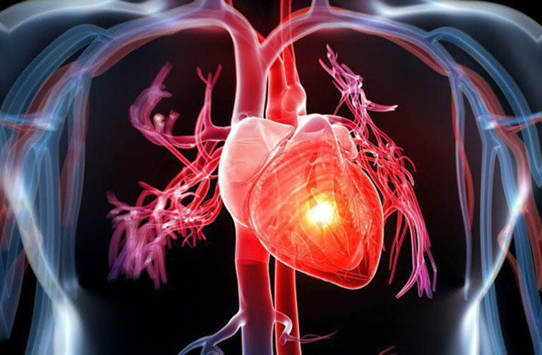 Bệnh tim to là gì? Dấu hiệu nhận biết