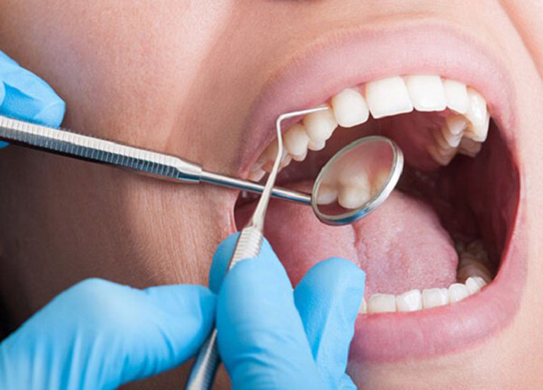 Bị viêm lợi có nên lấy cao răng không?