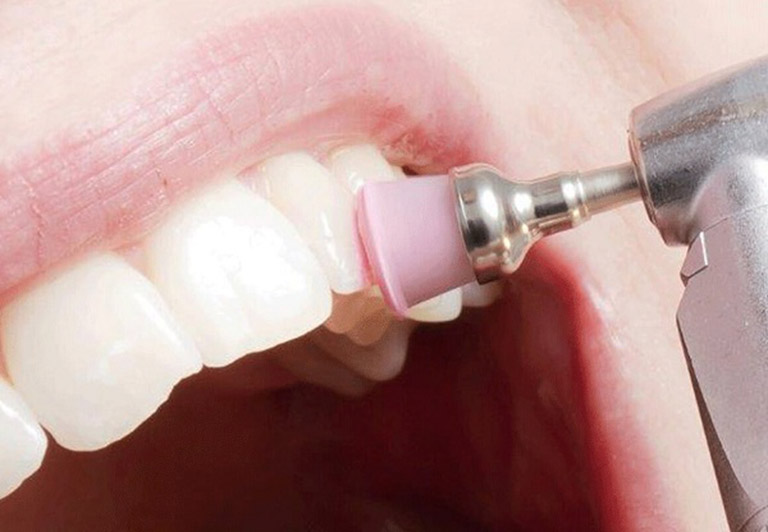 Một số lưu ý khi lấy cao răng cho người viêm lợi