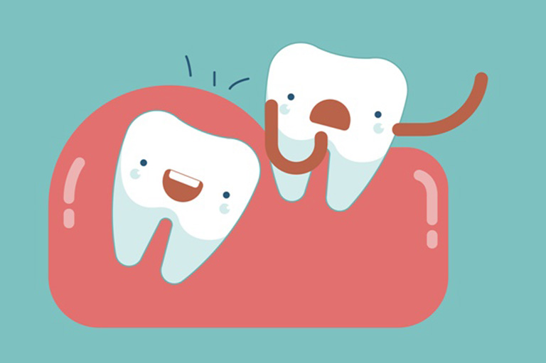 Lợi trùm răng khôn là gì? 