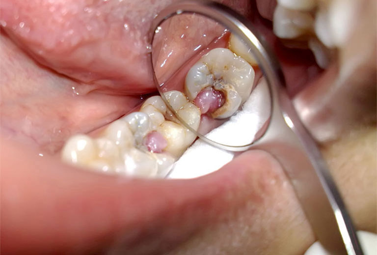 Nguyên nhân gây ê buốt răng hàm dưới