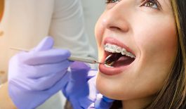 Khắc phục tình trạng niềng răng bị sưng lợi
