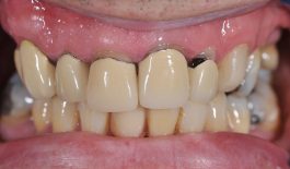 Nguyên nhân gây viêm lợi sau khi bọc răng sứ
