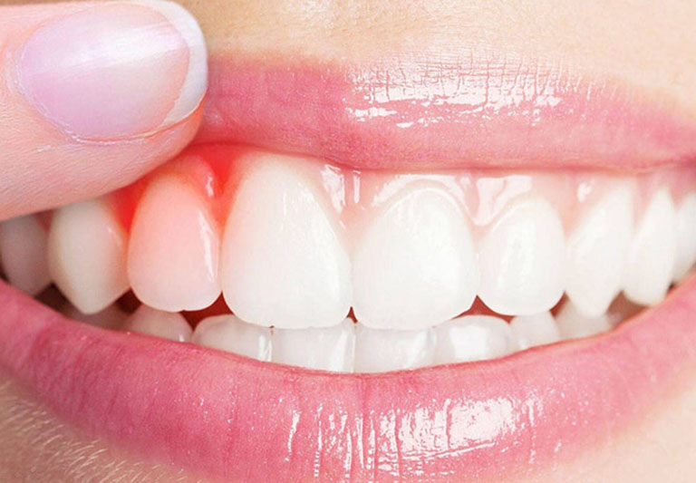 Chăm sóc và phòng tránh viêm lợi sau khi bọc răng sứ