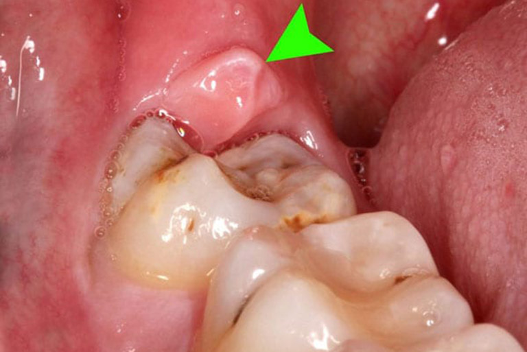 Viêm lợi trùm răng khôn có nên uống thuốc không? 