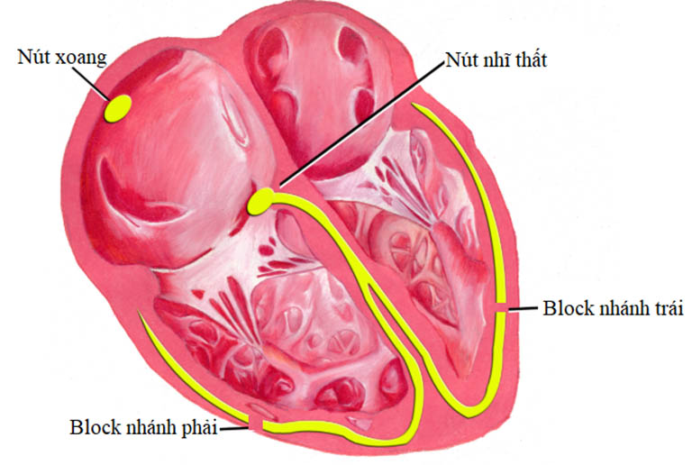 Nhồi máu cơ tim block nhánh phải là gì?