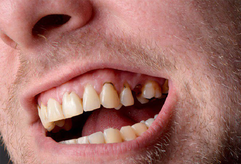 Cách chữa sâu răng bằng lá ổi có thật sự hiệu quả?