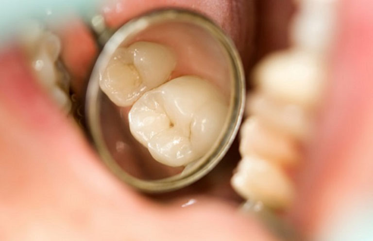 Dùng lá tía tô chữa sâu răng có hiệu quả không?