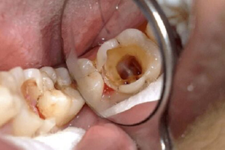 Răng cấm bị sâu là gì?