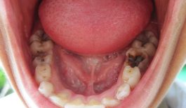 Sâu răng cấm có nguy hiểm không?