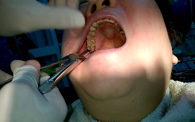 Sâu răng cấm có cần nhổ không?