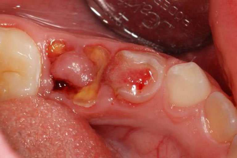 Nhận biết tình trạng răng sâu bị lồi thịt