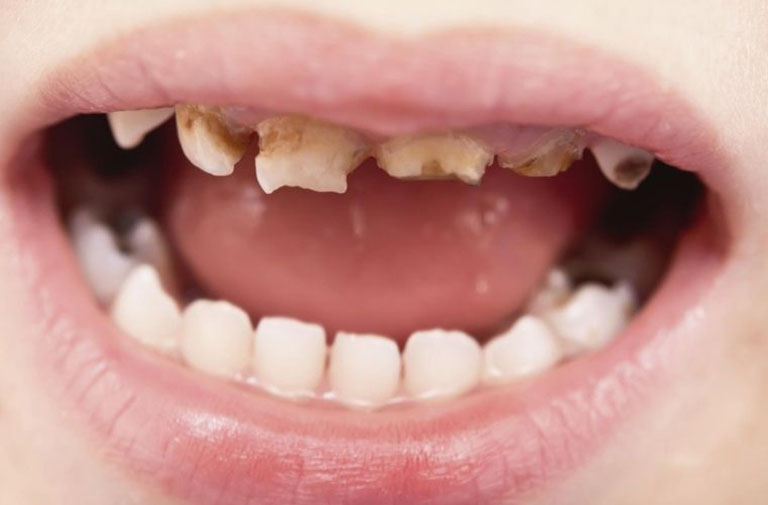Răng sâu lồi thịt gây ra tác hại gì?