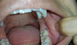 Chăm sóc, bảo vệ ngăn ngừa tái phát sâu răng số 7