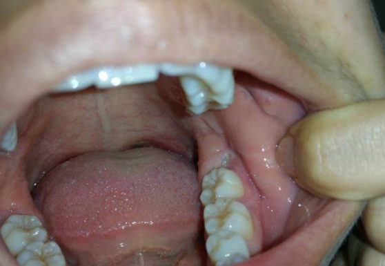 Chăm sóc, bảo vệ ngăn ngừa tái phát sâu răng số 7