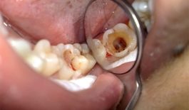 Răng sâu bị chảy máu do nguyên nhân nào