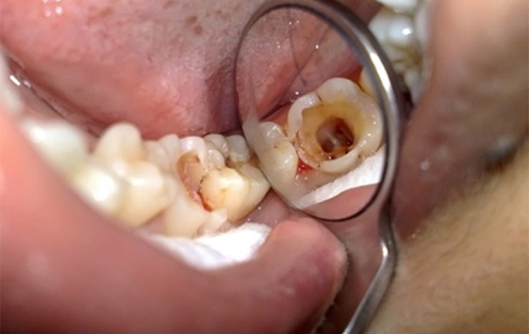 Răng sâu bị chảy máu do nguyên nhân nào